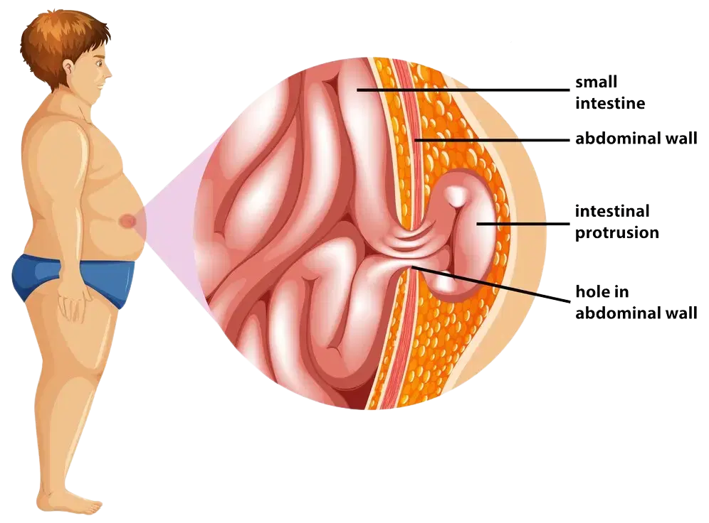 Hernia Surgery