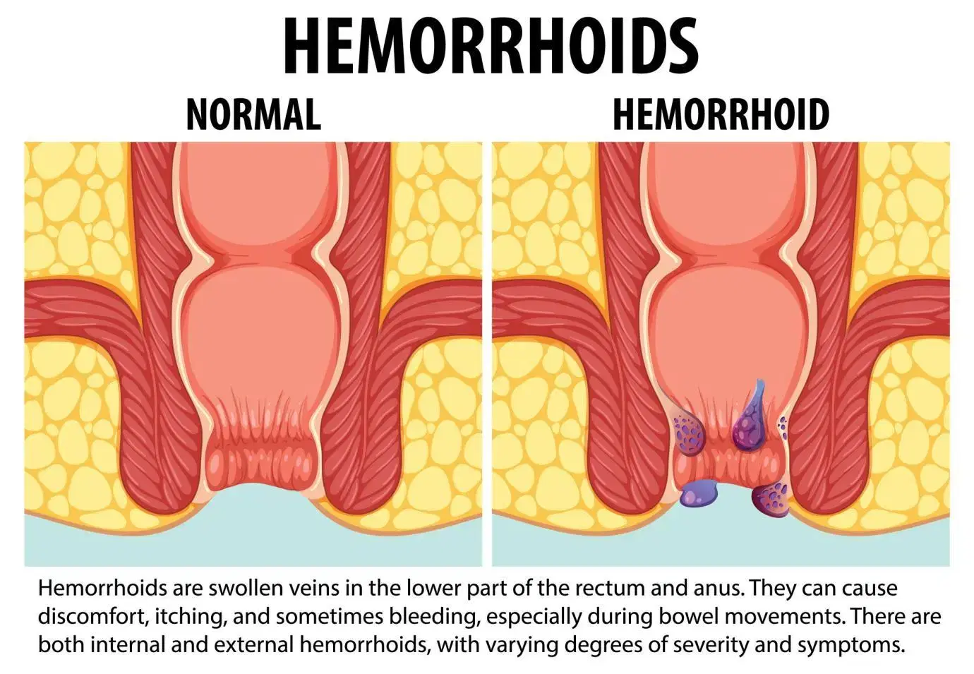 Piles Treatment