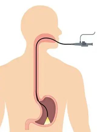 Oesophageal Manometry: Measuring the Function of Your Esophagus