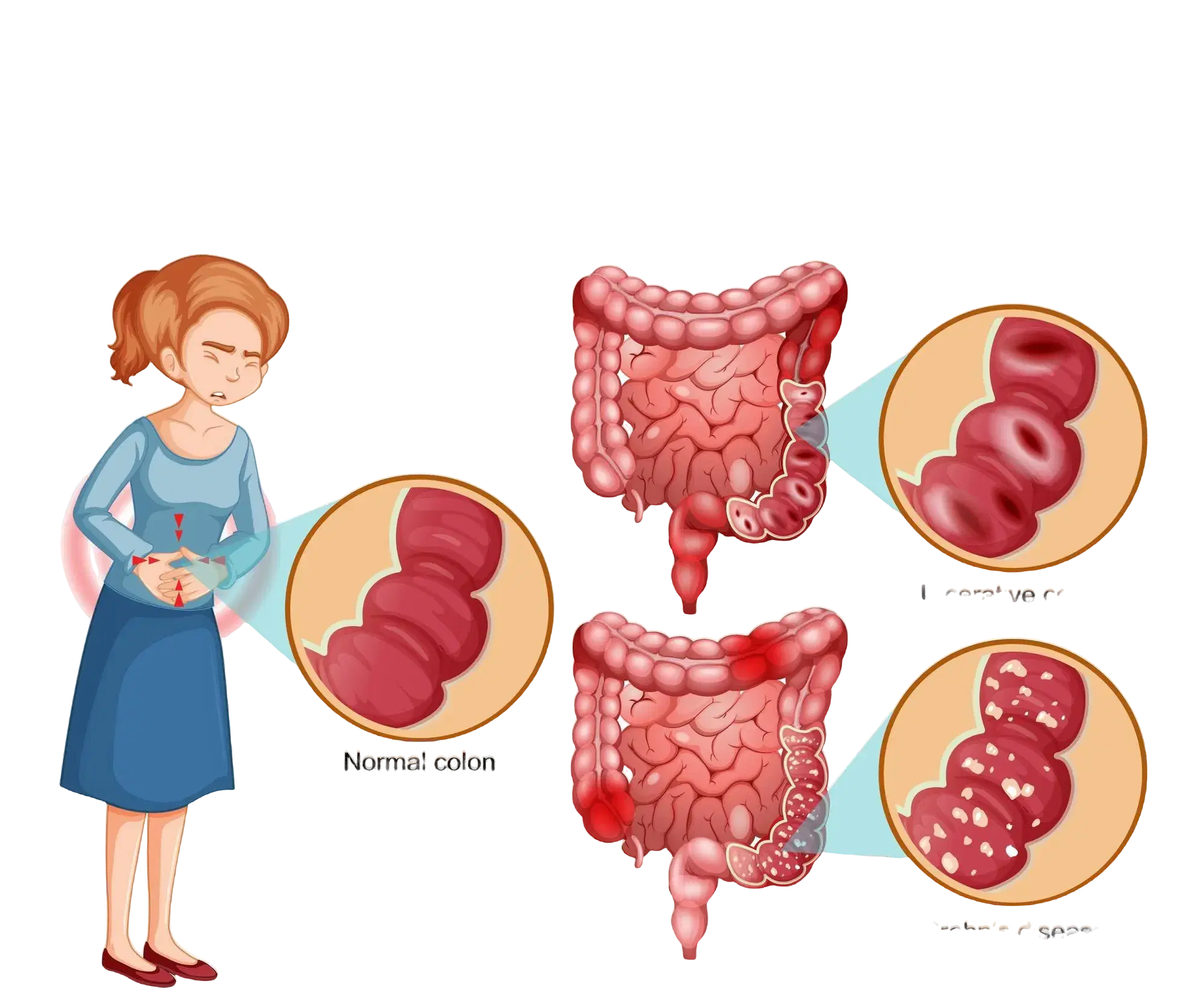 Why is it important to raise awareness about IBD?